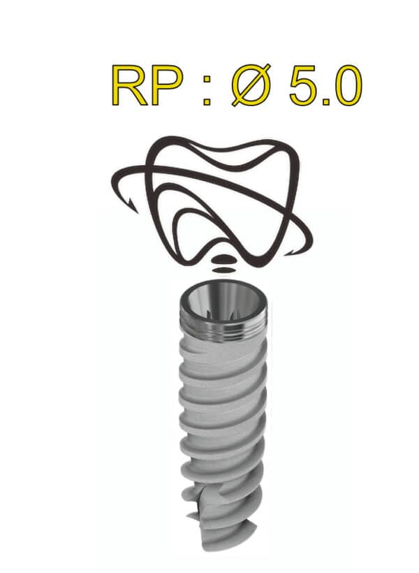 Implant Active Hex RP 5mm. Dess Dental implantat